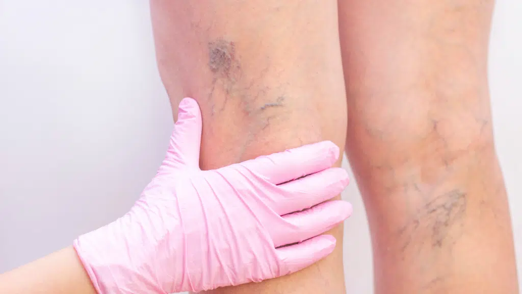 treat varicose veins