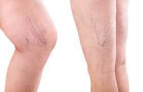dermatologist spider veins