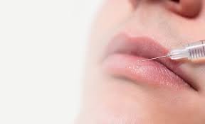 Tips for Lip Fillers:
