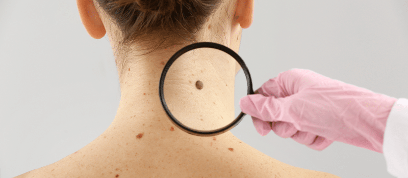 skin cancer dermatologist