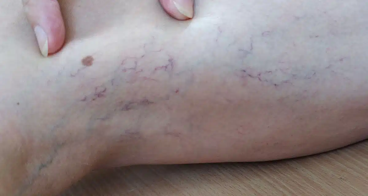 dermatologist spider veins