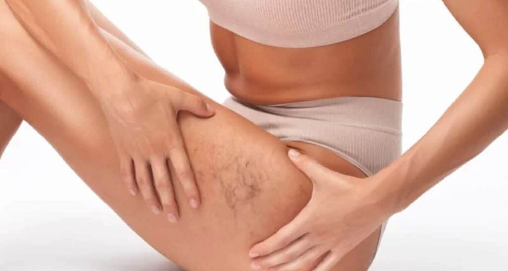 dermatologists for spider veins